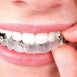 Invisalign® Clear Aligners